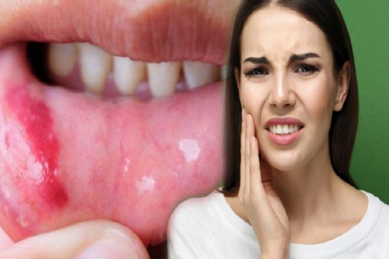 Ağız içi yara nedir & neden olur? Doğal yolla ağız içi yaraları geçirme…