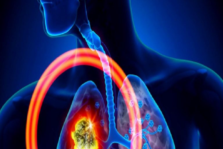 Akciğer kanserinin belirtileri nelerdir? Akciğer kanseri tedavisi var mıdır? Akciğer kanserini önlemek için…