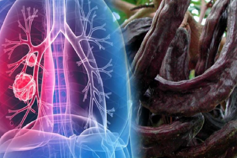 Akciğer lekesinin belirtileri nelerdir? Akciğer lekesi öldürür mü?