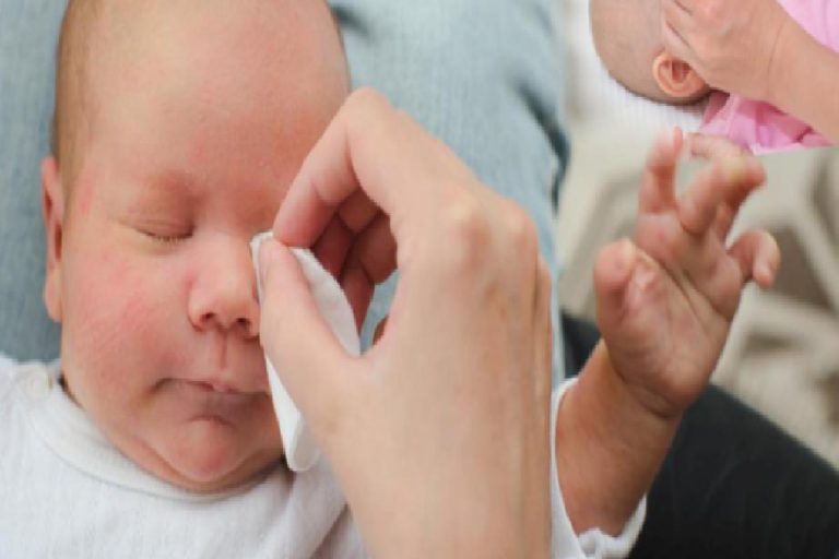 Bebeklerde çapak nasıl temizlenir? Bebeklerde göz çapaklanması neden olur ?