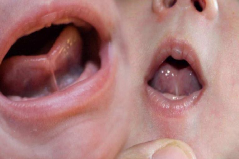 Bebeklerde dil bağı (Ankiloglossi) nedir? Dil bağı belirtileri ve tedavisi