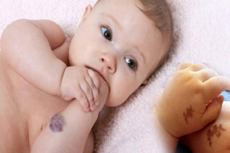 Bebeklerde doğum lekesi neden olur, kalıcı mı? Doğum lekesi çeşitleri neler? Saraçoğlu’ndan kür