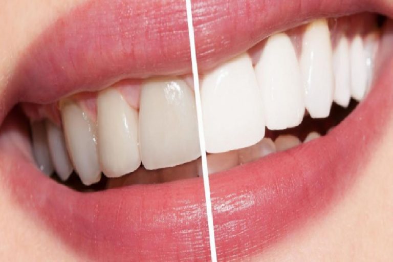 Beyaz dişler için öneriler nelerdir? Evde doğal yolla yapılan diş beyazlatma kürü…