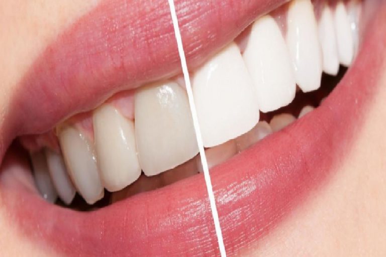 Beyaz dişler için öneriler nelerdir? Evde doğal yolla yapılan diş beyazlatma kürü…