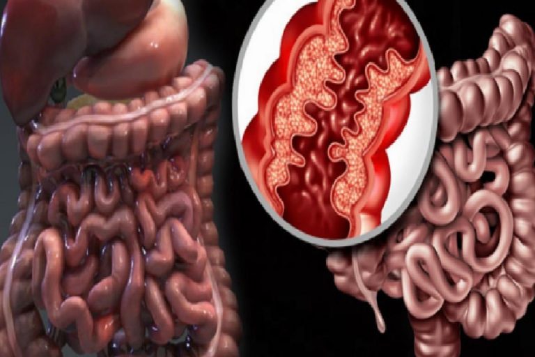 Crohn hastalığı nedir? Crohn hastalığının belirtileri nelerdir? Crohnun tedavisi var mıdır?