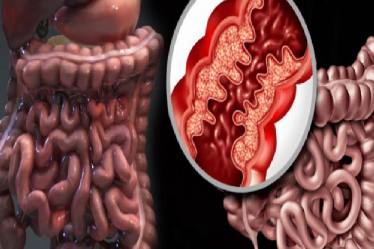 Crohn hastalığı nedir? Crohn hastalığının belirtileri nelerdir & Tedavisi