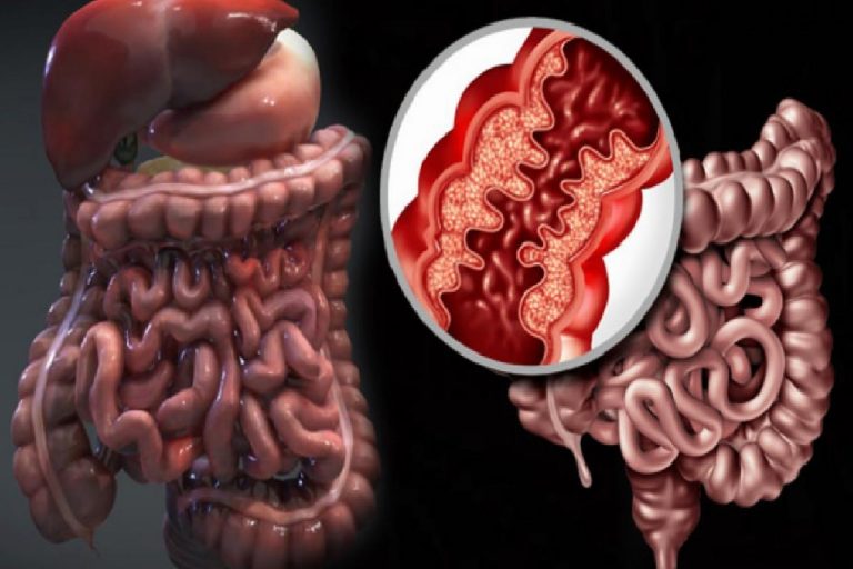 Crohn hastalığı nedir? Crohn hastalığının belirtileri & Tedavisi