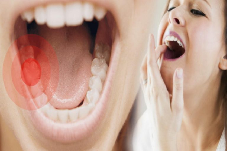 Diş apsesi neden olur? Belirtileri nelerdir & kaç günde geçer? Diş apsesine doğal çözümler…