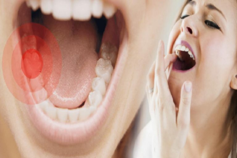 Diş apsesi neden olur? Belirtileri nelerdir ve kaç günde geçer? Diş apsesine doğal çözümler…