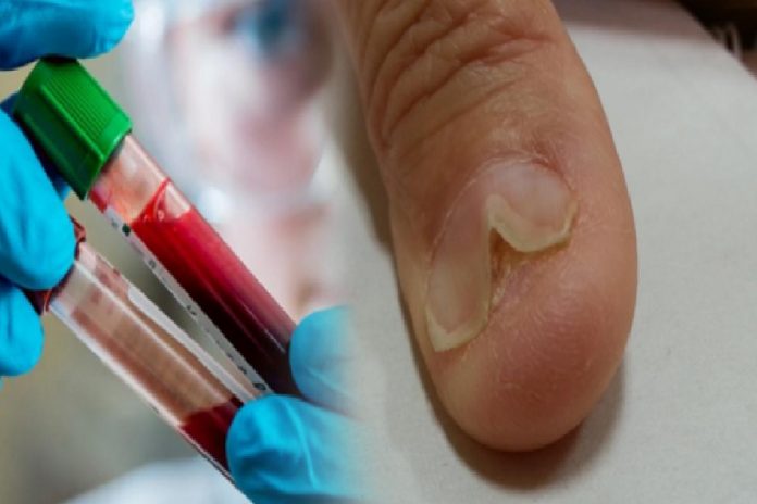 ferritin-eksikligi-nedir-ferritin-eksikliginin-belirtileri-nelerdir-ferritin-iceren-besinler-nelerdir-kOafw4Yr.jpg