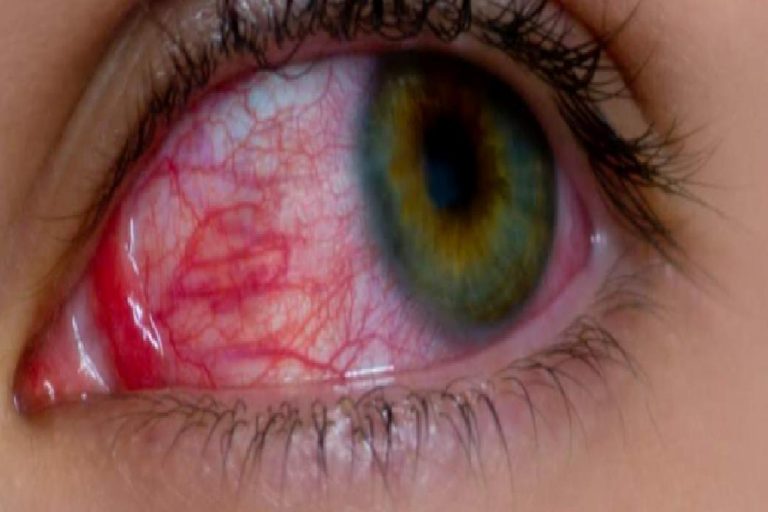 Göz alerjisi neden olur? Göz alerjisinin belirtileri nelerdir? Göz alerjisine ne iyi gelir?