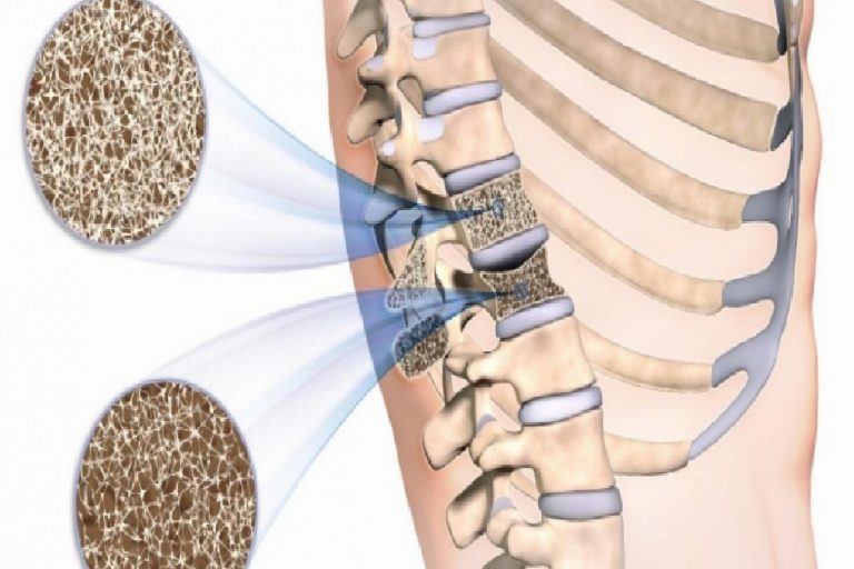 Kemik erimesi (Osteoporoz) nedir? Kemik erimesi belirtileri nelerdir ve tedavisi var mıdır?