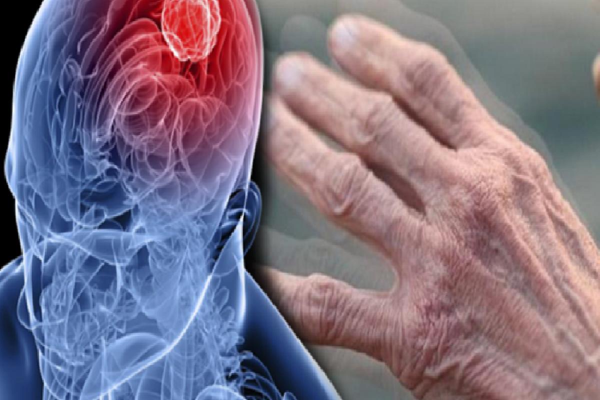 Parkinson Hastalığı Nedir Parkinsonun Belirtileri Nelerdir Parkinson Nasıl Tedavi Edilir 0386