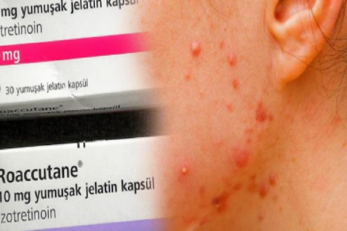 roaccutane-nedir-nasil-kullanilir-roaccutane-yan-etkileri-nasil-gecer-ktwbt9dt.jpg