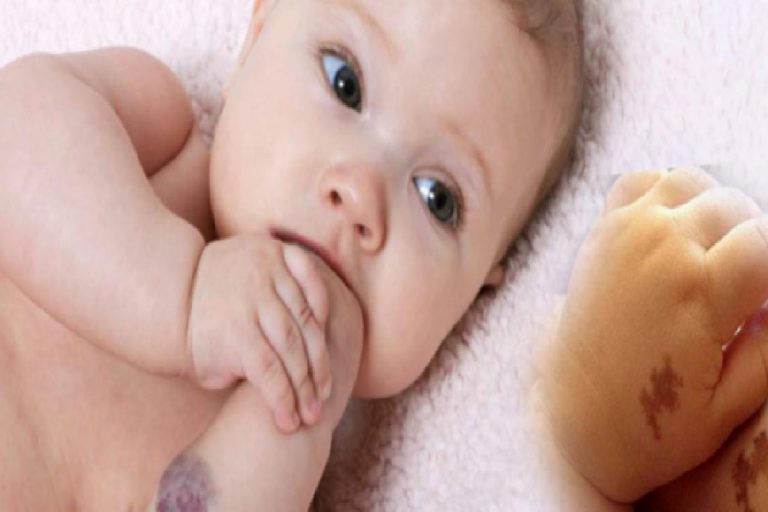 Bebeklerde doğum lekesi neden olur ve kalıcı mı? Doğum lekesi çeşitleri! Saraçoğlu’ndan kür