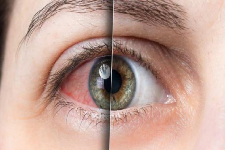 Göz sağlığında yapılan hatalar nelerdir? Yaz aylarında gözlere dikkat!