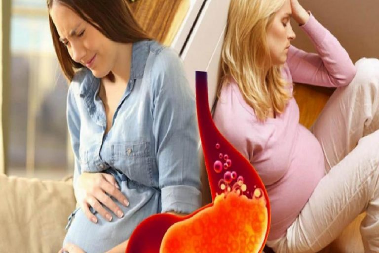 Hamilelikte mide yanması neden olur? Hamilelikte mide yanmasına ne iyi gelir?