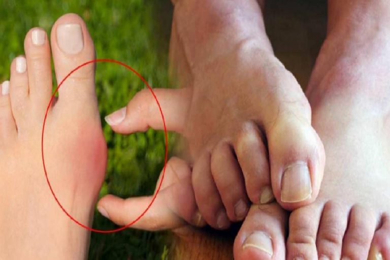 Taraklı ayak nedir ve taraklı ayak nasıl tedavi edilir? Halluks Valgus nasıl incelir?
