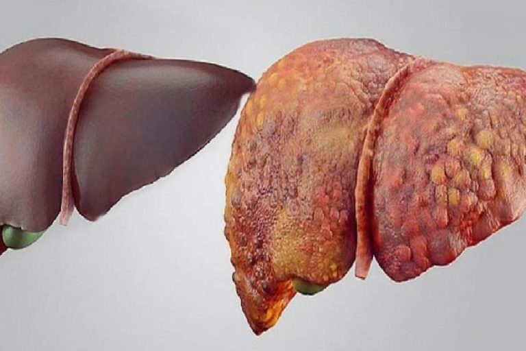 Karaciğer yetmezliği belirtileri nelerdir? Karaciğer yetmezliği tedavisi nasıl yapılır?